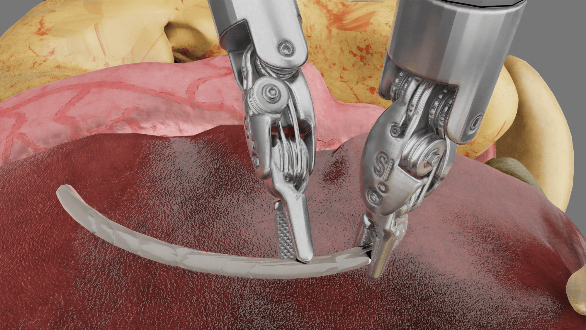 Nvidia's Surgical Robotics AI Tools Transform Operating Room Precision at GTC 2026