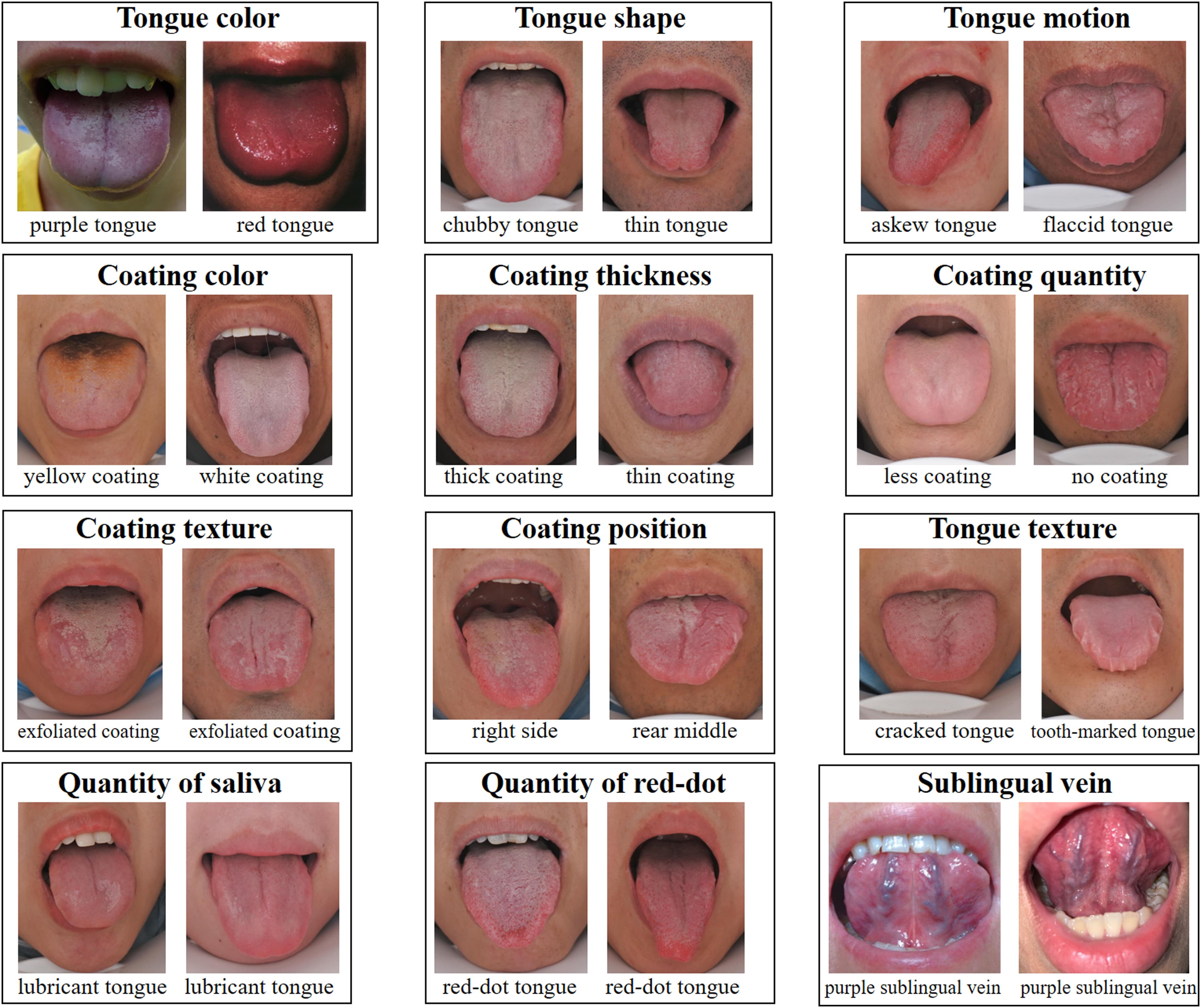 Revolutionizing Healthcare: AI Tongue Analysis