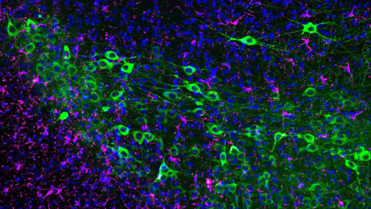 Immunotherapy Blocks Neuronal Decline in Parkinson's Disease Models